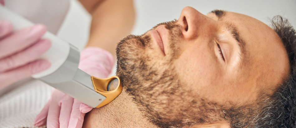 Définition de la barbe au laser